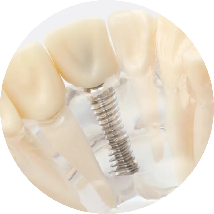 インプラント治療